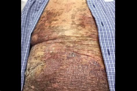 Dermdx Rash On Arms And Trunk With Hyperpigmentation Dermatology Advisor