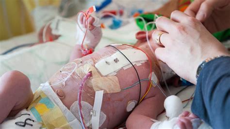 Patent Ductus Arteriosus In Preterm Infants Johns Hopkins Medicine