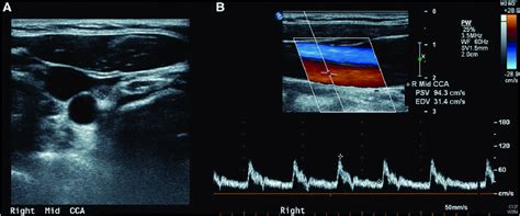 Normal Carotid Ultrasound Sonography Vascular Ultrasound Diagnostic
