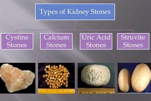 Types Of Kidney Stones Dr Irfan Shaikh Urolife Clinic Pune