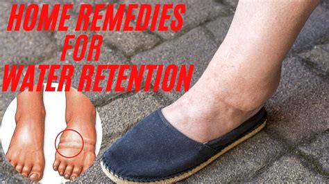 What Causes Water Retention Edema And How To Avoid It How To Get Rid
