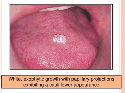 Benign Tumors Of Epithelial Origin