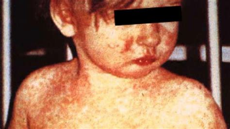Measles Mumps Tuberculosis Outbreaks Are Anti Vaxxers To Blame