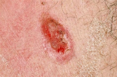 Nodular Infiltrative Basal Cell Carcinoma Stock Image C0370927