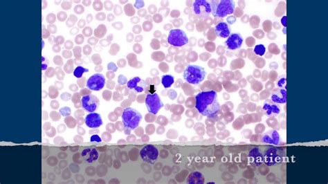 Juvenile Myelomonocytic Leukemia Jmml Peripheral Blood Smear 2 Year