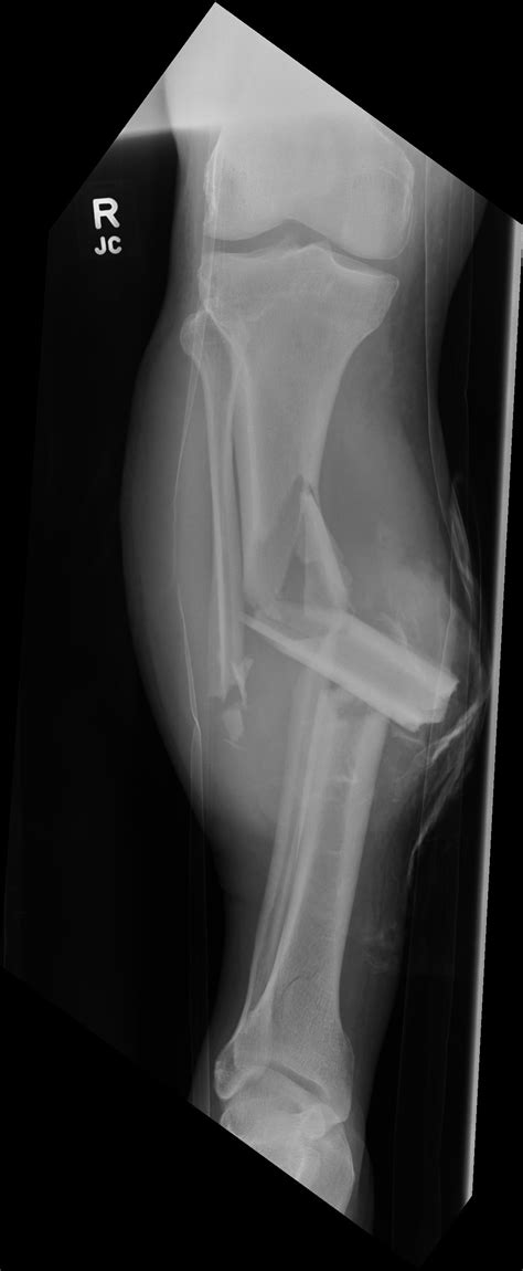 Open Comminuted Fractures Of The Tibia And Fibula Radiology