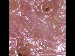 Look At This Demodex Mite Moving On The Surface Of The Skin Youtube