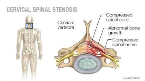 Mayo Clinic Q And A Treating Cervical Spinal Stenosis Mayo Clinic