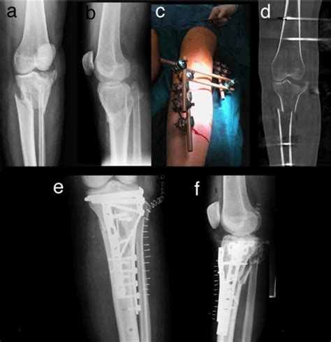 Sequential Treatment Of Tibial Plateau Fracture A Radiograph Of