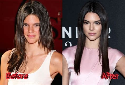 Kendall Jenner Plastic Surgery Before And After Kendall Jenner Plastic Surgery Kylie Jenner