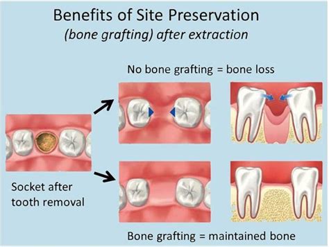 Bone Grafting After Tooth Extraction By Your Dentist In Fort Lauderdale And Lauderdale By The Sea