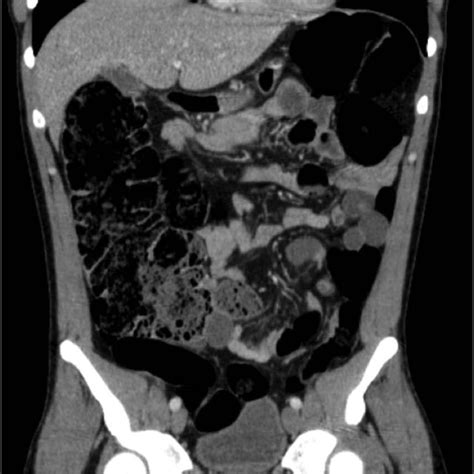 Abdominal Computed Tomography Showing Colonic Distension Without
