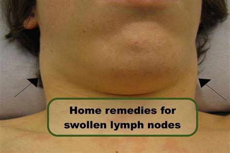 Cbd Oil Swollen Lymph Nodes
