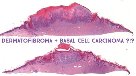 Dermatofibroma True Basal Cell Carcinoma Basaloid Hair Follicle