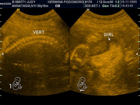 Ultrasonografi digunakan untuk beragam keperluan, mulai dari memeriksa kondisi janin, mendeteksi penyakit, sampai membantu dokter dalam tindakan bedah atau pengambilan. Gambar Uncategorized Parva Lilium Page 2 Bingung Gambar Janin Perempuan di Rebanas - Rebanas