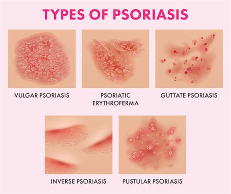 The Ultimate Guide To Psoriasis What Causes It And How To Treat It