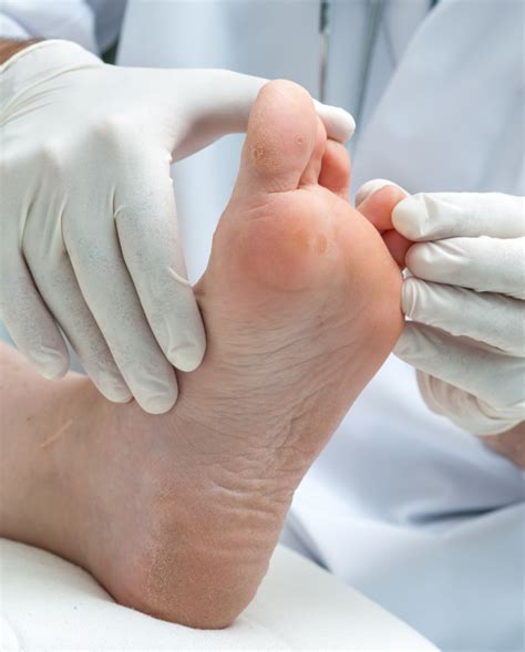 Athletes Foot Treatments Mesa Az Sagebrush Dermatology