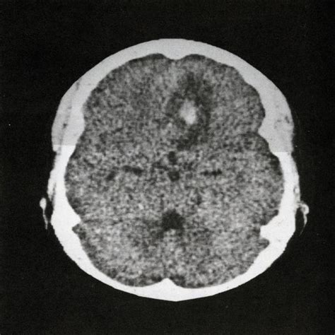 Computed Tomography Ct Scan Of Brain Showing Subarachnoid Hemorrhage