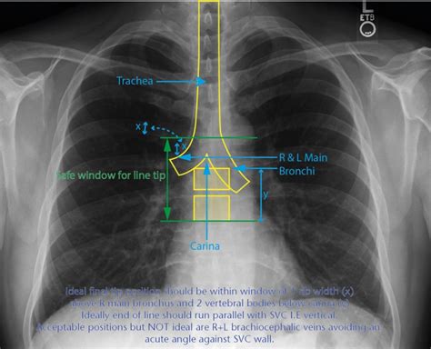 Central Venous Catheter Tip Position On Chest Radiographs Wright