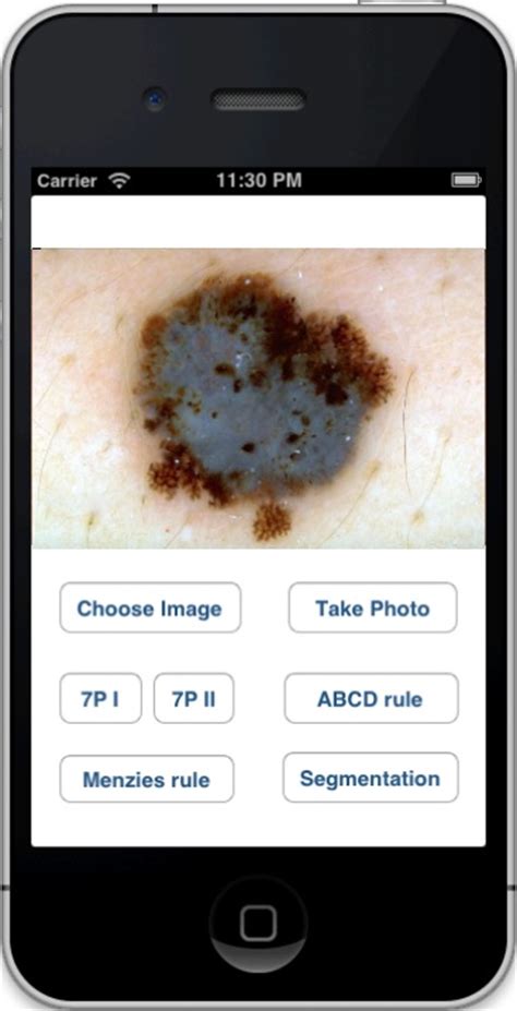 University Of Houston Professor Develops App To Detect Skin Cancer