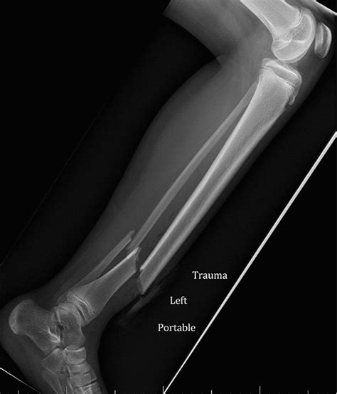 Anderson Silva Broken Leg X Ray