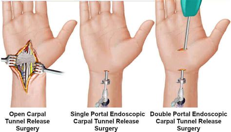 Pros And Cons Of Endoscopic Surgery For Carpal Tunnel