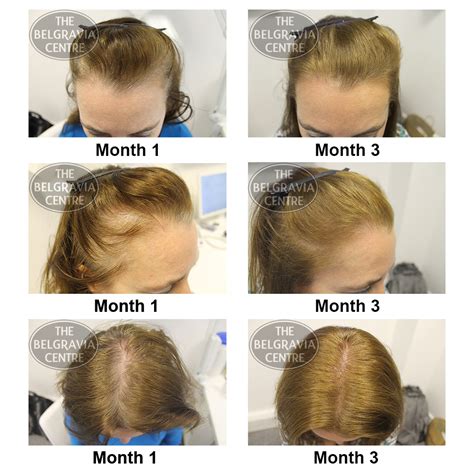 During treatment for hair loss, you can expect to return to the doctor periodically to determine the response to hair loss doesn't only happen to men. Success Story Alert! New Female Hair Loss Treatment Entry