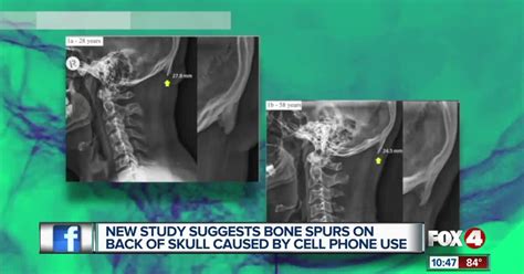 New Study Suggests Bone Spurs On Skull Caused By Cell Phone Use