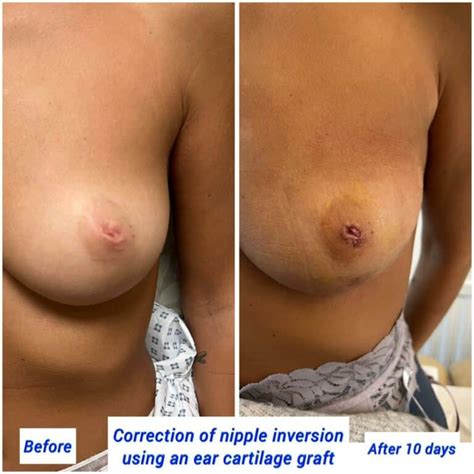 Nipple Procedures Harley Clinic