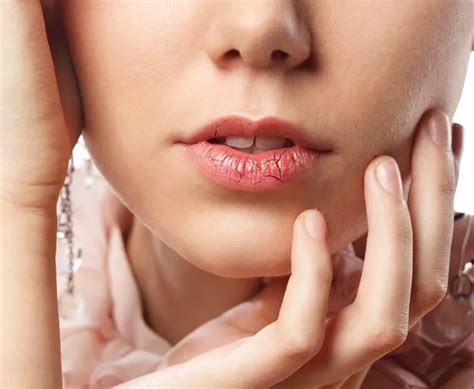 Why Do We Get Dry Chapped Lips In Winter And What Are The Best Ways To