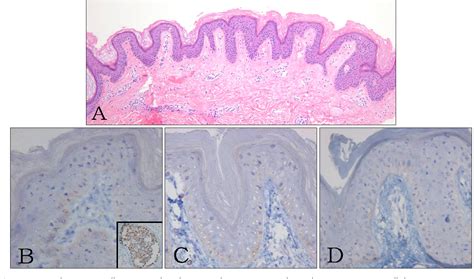 Pdf Unilateral Nevoid Acanthosis Nigricans With A Submammary Location