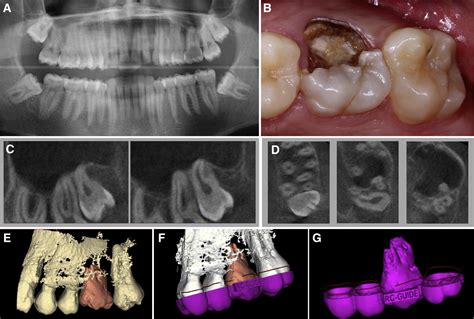 Outcome Of Autotransplantation Of Mature Third Molars Using 3