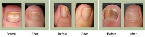 Toenail falling off for no reason? Laser Treatment Results - Beauchamp Foot Care - Beauchamp ...