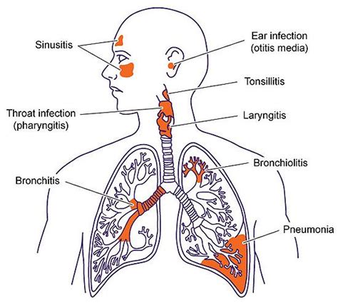 Upper Respiratory Tract Infection Causes Symptoms Treatment Upp