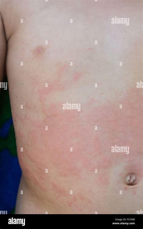 Eruzioni Cutanee Da Allergia Sul Torse Di Un Bambino Di 2 Anni Il