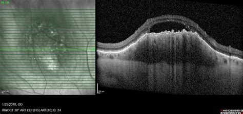 Choroidal Melanoma - Retina Image Bank