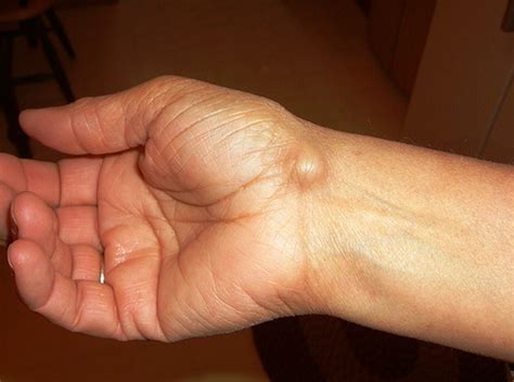 Ganglion Cyst Wrist Pictures Treatment Surgery Causes Symptoms