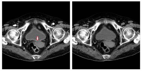 Диета при удалении мочевого пузыря Диета при удалении мочевого пузыря