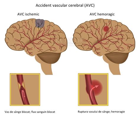 Accident Vascular Cerebral AVC