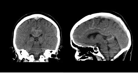 Dural Sinus Thrombosis With Sah