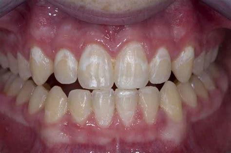 White Spots On Gums