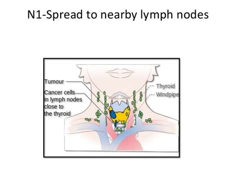 Ca thyroid