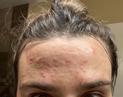 Acne Out Of Nowhere My Forehead Erupted In These Tiny Hard Red Bumps