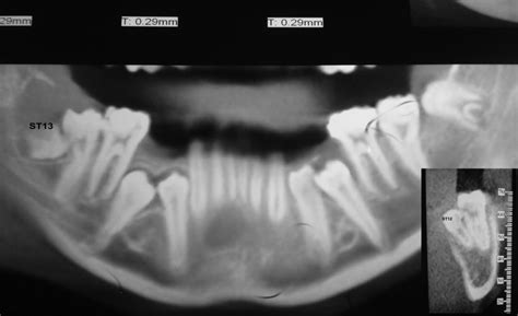 Non Syndromic Multiple Supernumerary Teeth Report Of A Case With 13