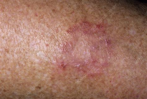 Ringworm Stock Image M2700261 Science Photo Library