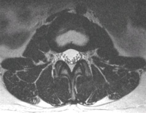 Mri Of The Lumbosacral Spine Axial And Coronal Section Showing An My