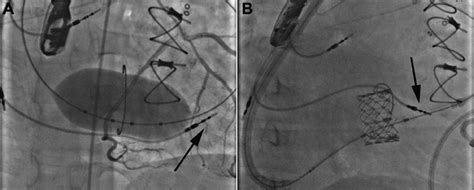 Transcatheter Valve In Ring Implantation For The Treatment Of Residual