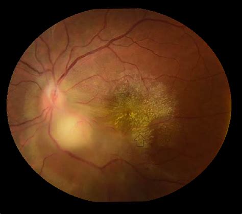 Cureus Ocular Tuberculosis Without A Lung Primary