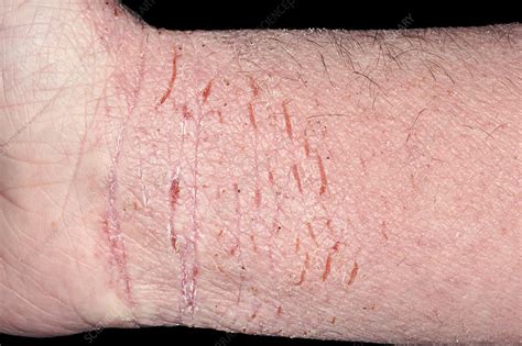 Severe Eczema On The Wrist Stock Image C0400987 Science Photo