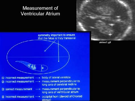 Fetal Lateral Ventricle Measurement